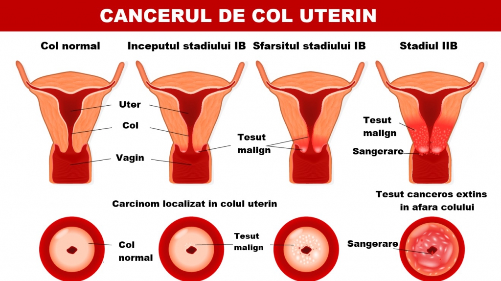 condilomul colului uterin pachet detoxifiere life care pareri