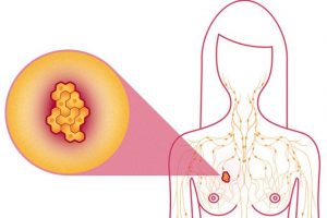 tumorile mamare tratament