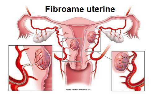 tratament fibrom uterin cluj