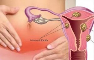 Desfundarea trompelor uterine